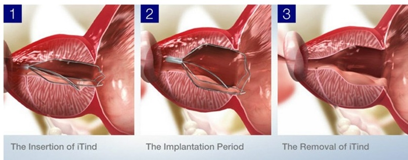 Revolutionary iTIND Solution for Urinary Issues in Youth at AINU